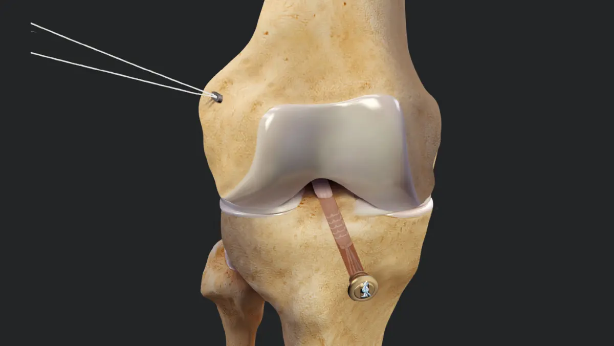 Arthroscopic ACL Reconstruction in Chennai | Orthomed Hospital