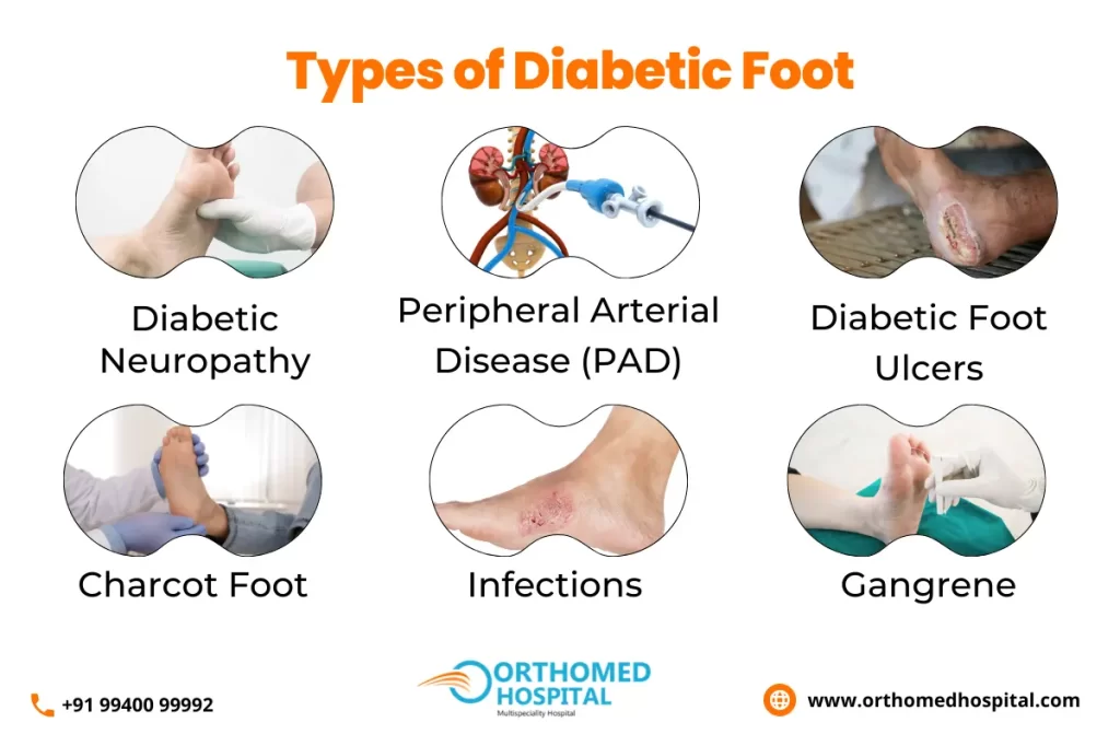 Diabetic Foot Clinic in Chennai | Orthomed Hospital